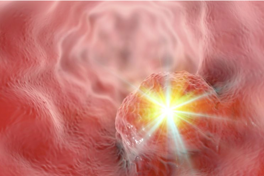 The CSF-1/CSF-1R axis is a potential target for future therapies to treat metastatic ESCC.