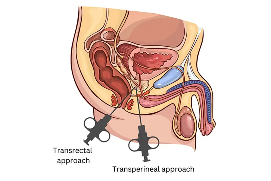 During a transperineal biopsy, the physician inserts the biopsy needle through the skin of the perineum directly into the prostate, thus eliminating the patient’s exposure to rectal bacteria and lowering the risk for infection that they are susceptible to through the transrectal approach.