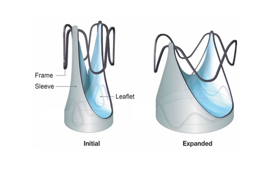 Autus Size-Adjustable Valve shown at initial and fully expanded sizes. Image courtesy of Autus Valve Technologies, Inc.