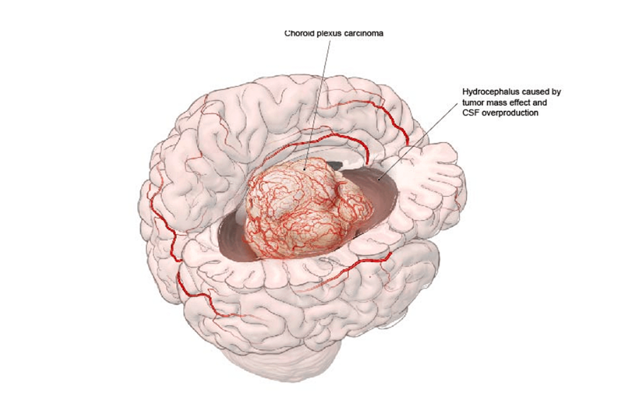 A choroid plexus carcinoma presenting with symptoms of hydrocephalus.