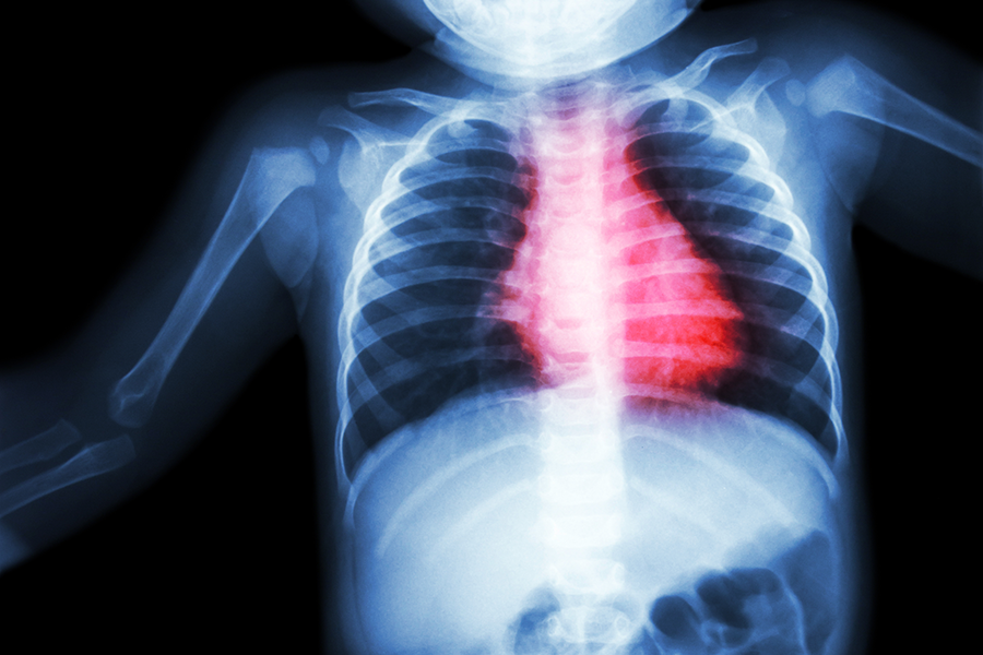 Reviewing Thirty Years of Pediatric Heart Transplants 12