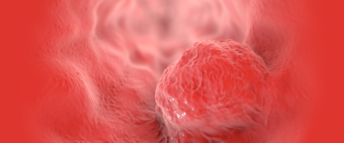 Esophageal Cancer On the Rise: What To Know