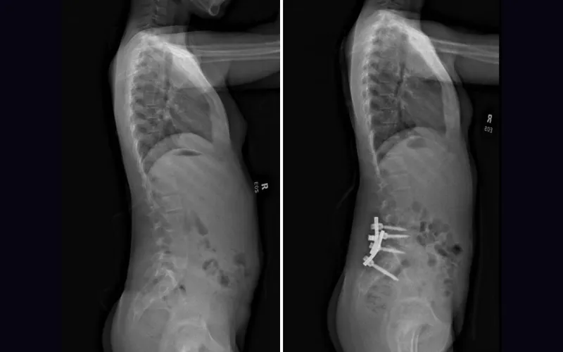 Images showing the spine of a patient before and after surgery.