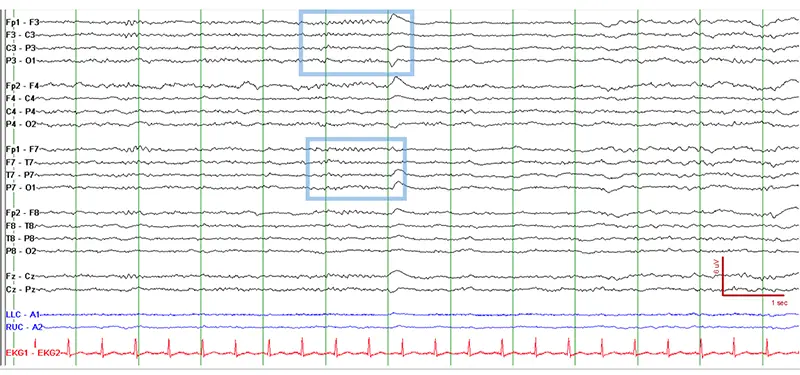EEG of a comatose patient showing sleep spindles in blue boxes