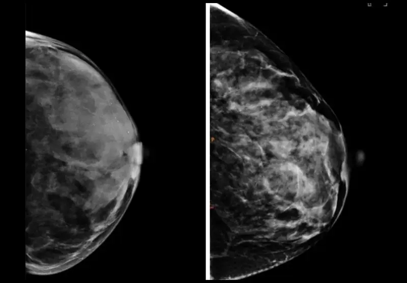 Mammogram images of two breasts that show different breast textures.