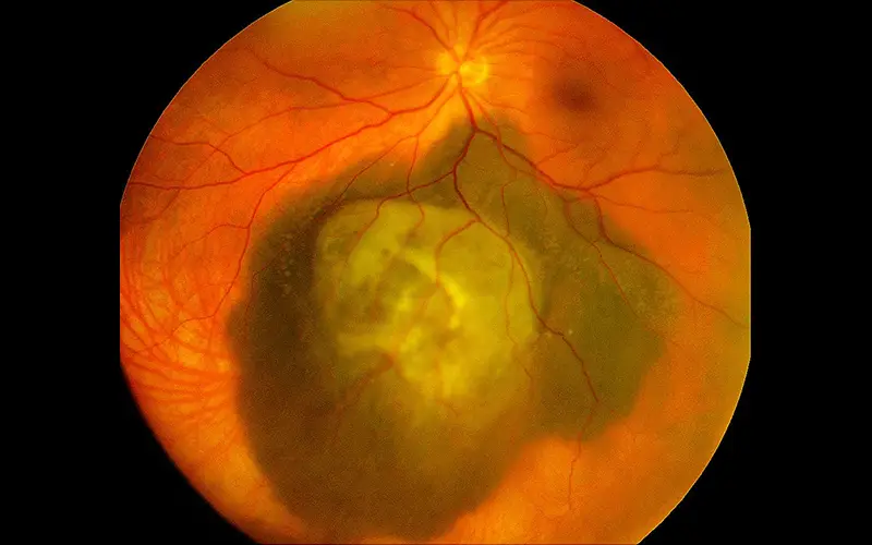 Image of choroidal melanoma of the left eye