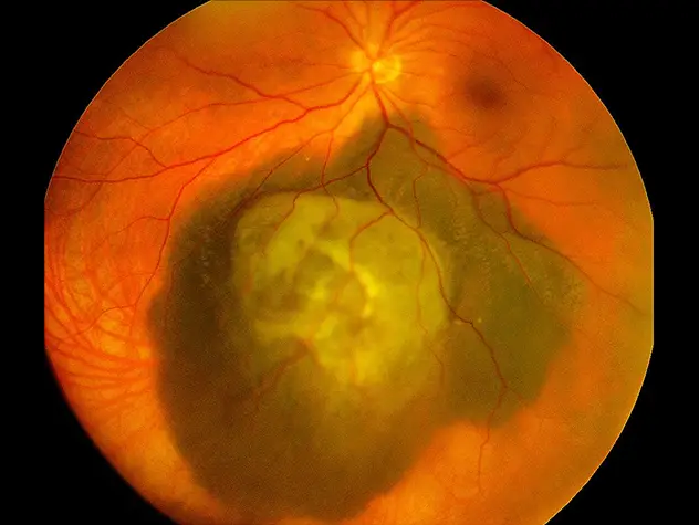 Expertise and Innovation in Ophthalmic Oncology Expand Options for Patients With Rare Eye Cancers