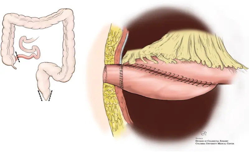 Illustration of the continent ileostomy also known as the K-pouch
