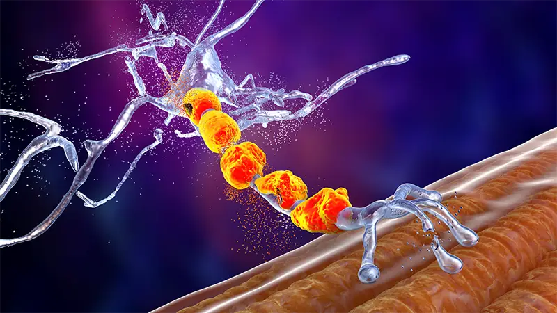 digital Illustration of the degeneration of motor neurons in ALS