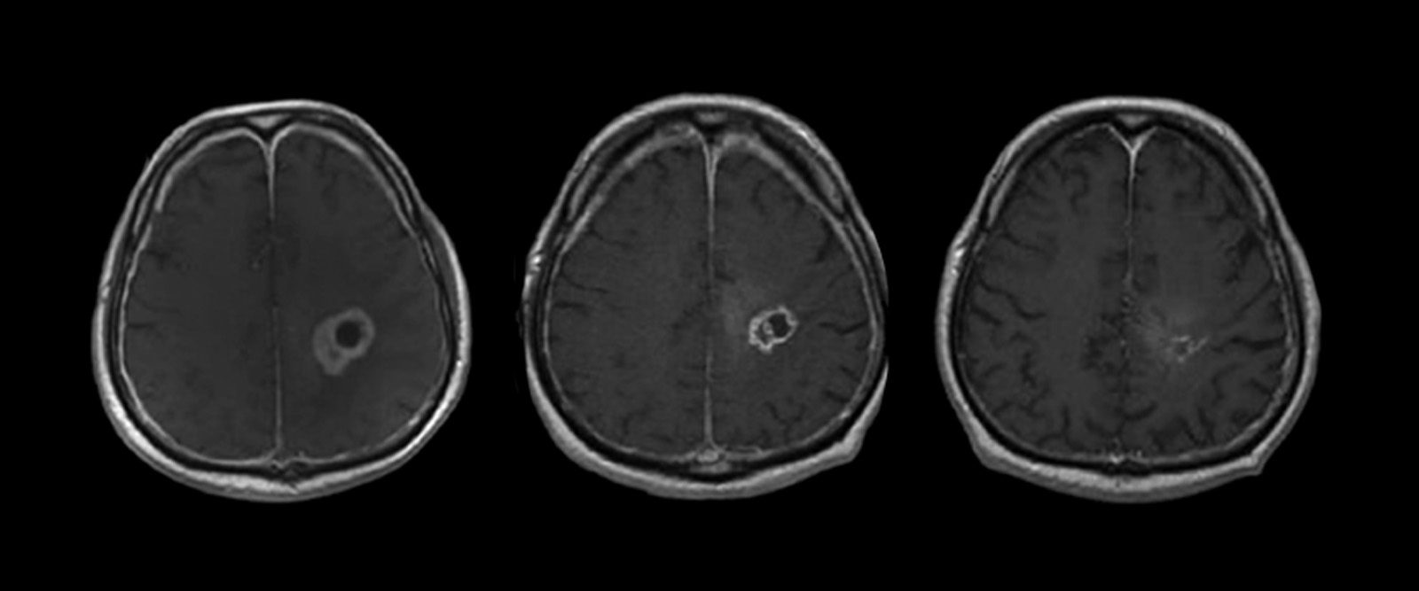 A New Approach for Treating Glioblastoma