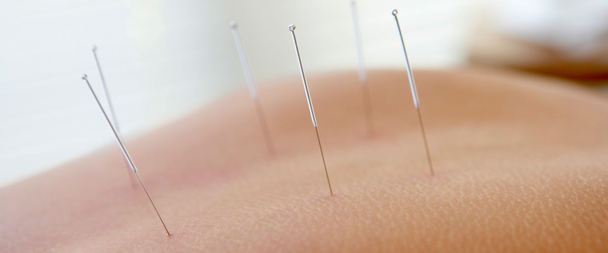 Acupuncture needles applied.