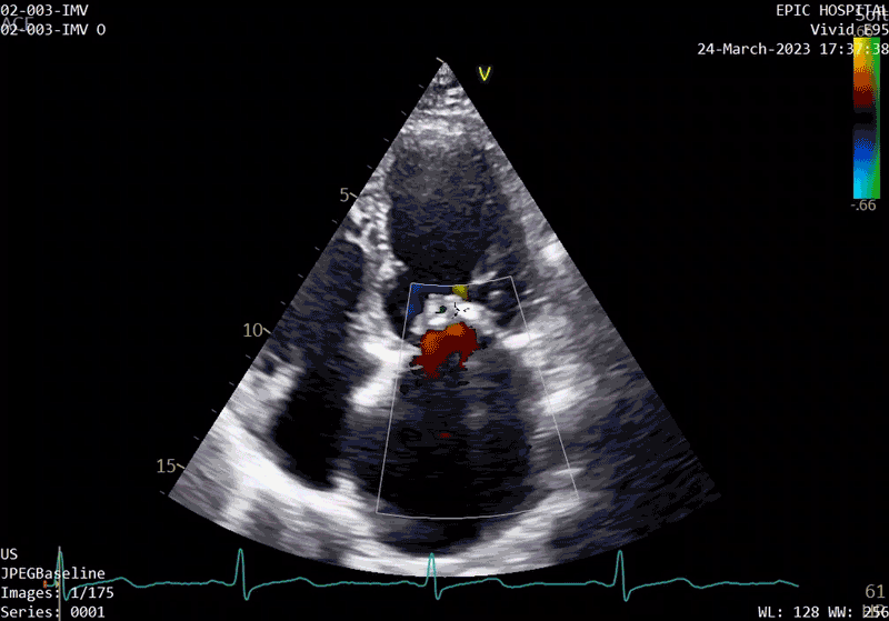 echocardiogram at baseline before surgery