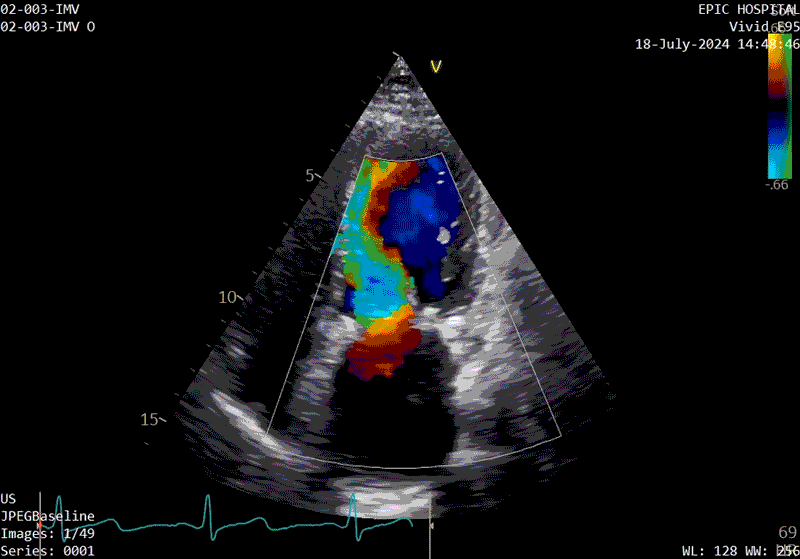 The patient’s echo at one-year after polymer valve implantation