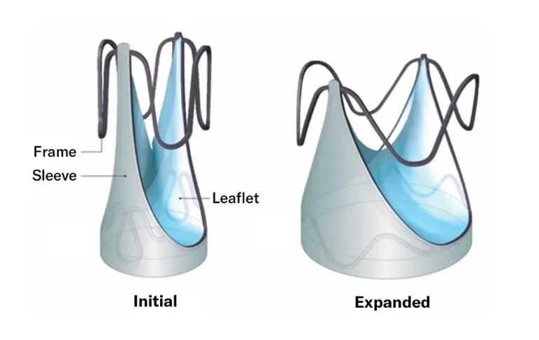 Image courtesy of Autus Valve Technologies, Inc.