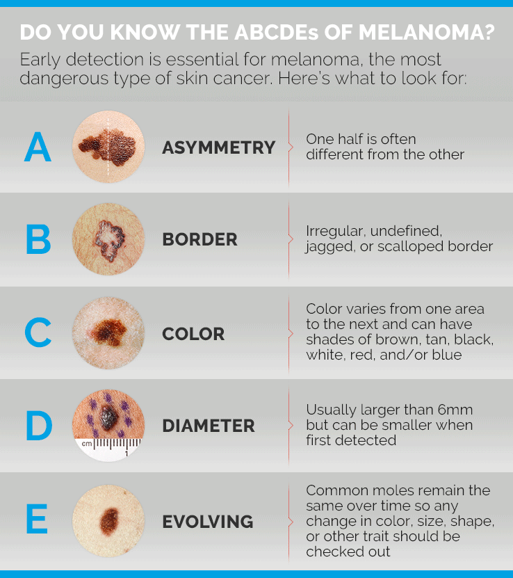 ABCDEs of Melanoma