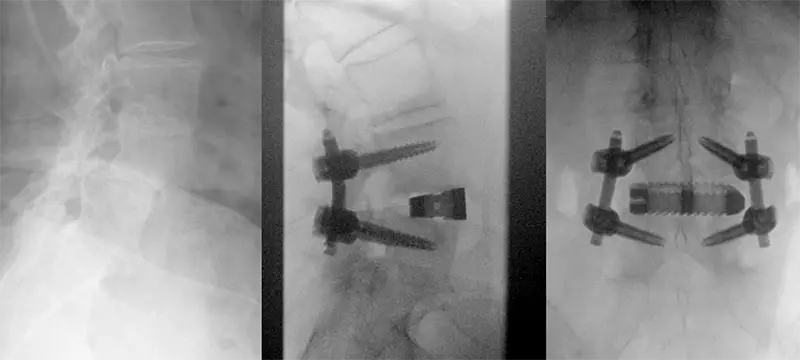 Medical image of L4-L5 spondylolisthesis treated with an interbody cage and screws.