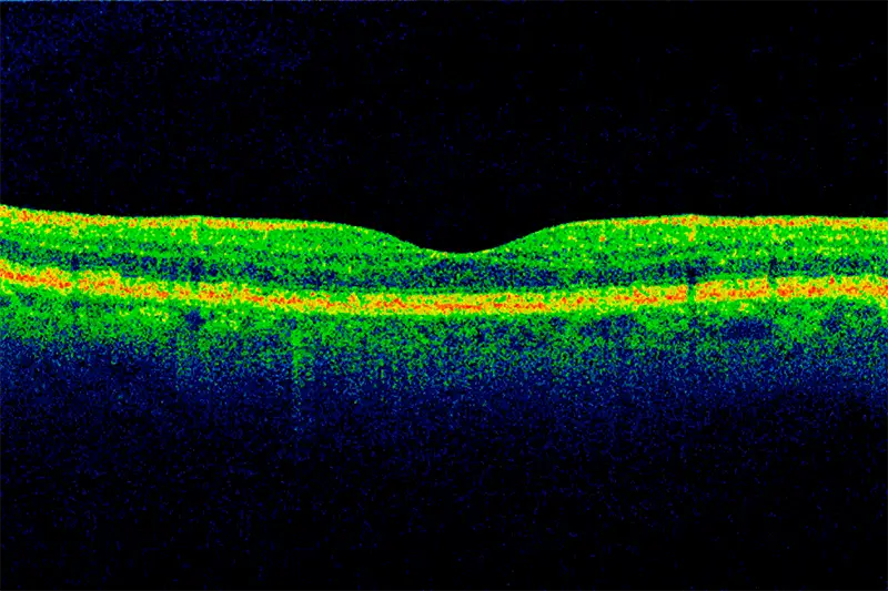 Optical coherence tomography scan of a section through the macula of the retina