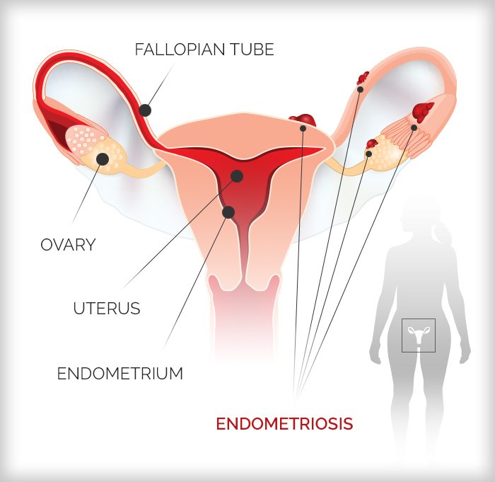 A diagram of endometriosis.