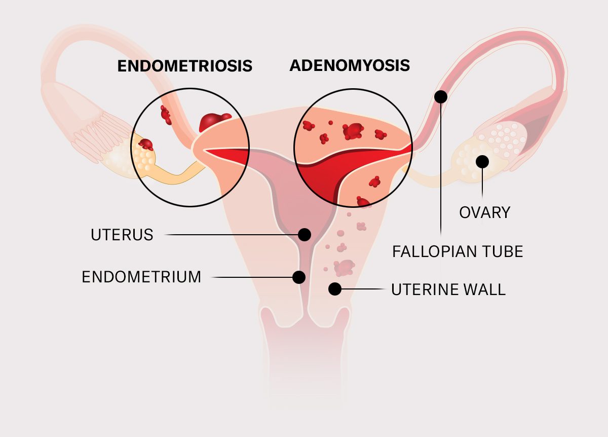 endometriosis-vs-adenomyosis-2