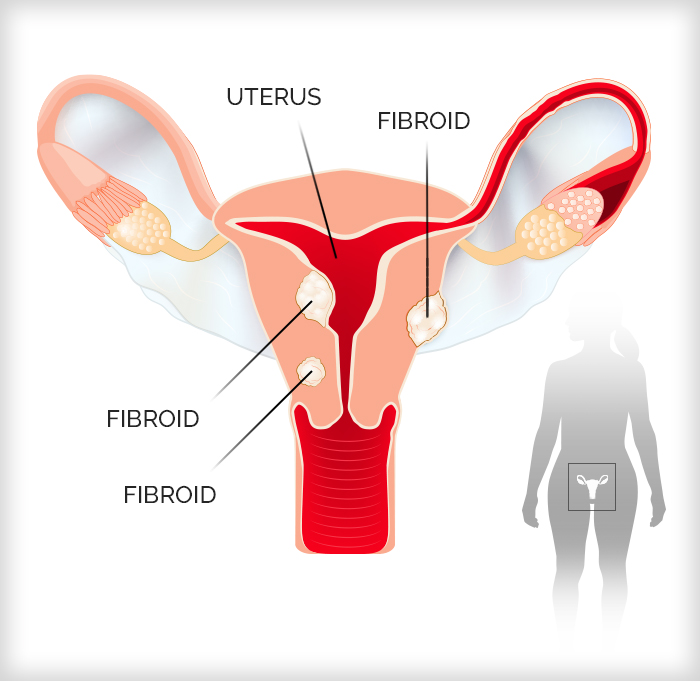 fibroids-symptoms-and-treatments-inset-diagram