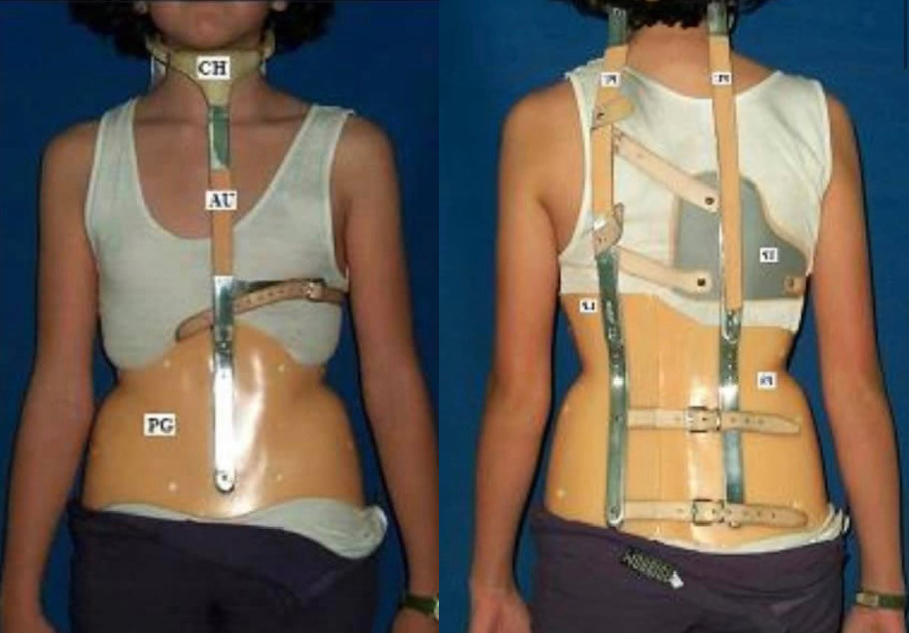 An example of Karen’s scoliosis brace.