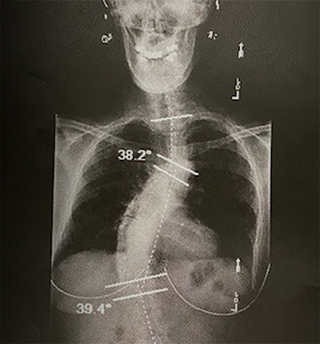 X-ray of Karen’s spine before corrective surgery.