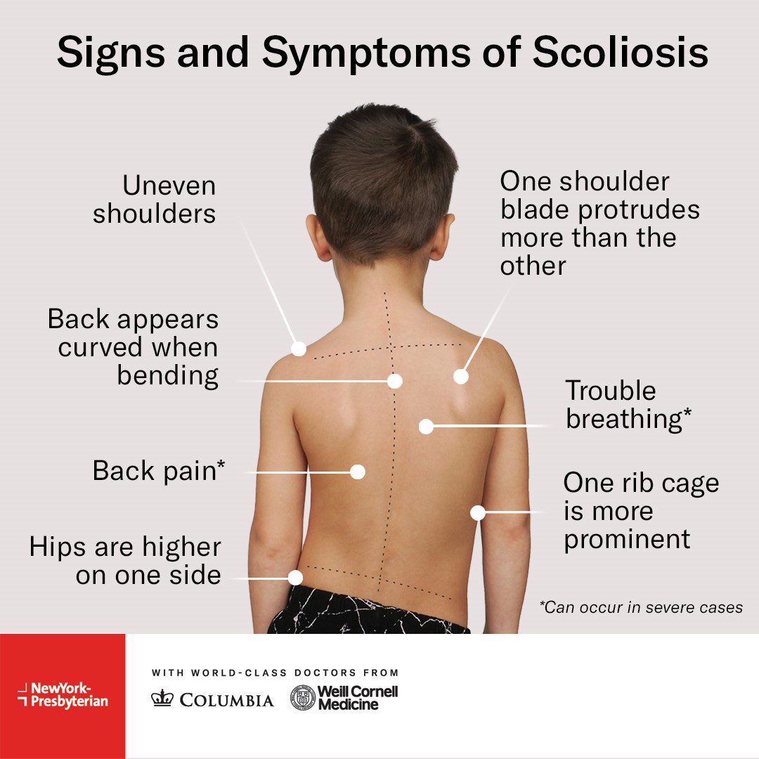 Signs and symptoms of scoliosis chart