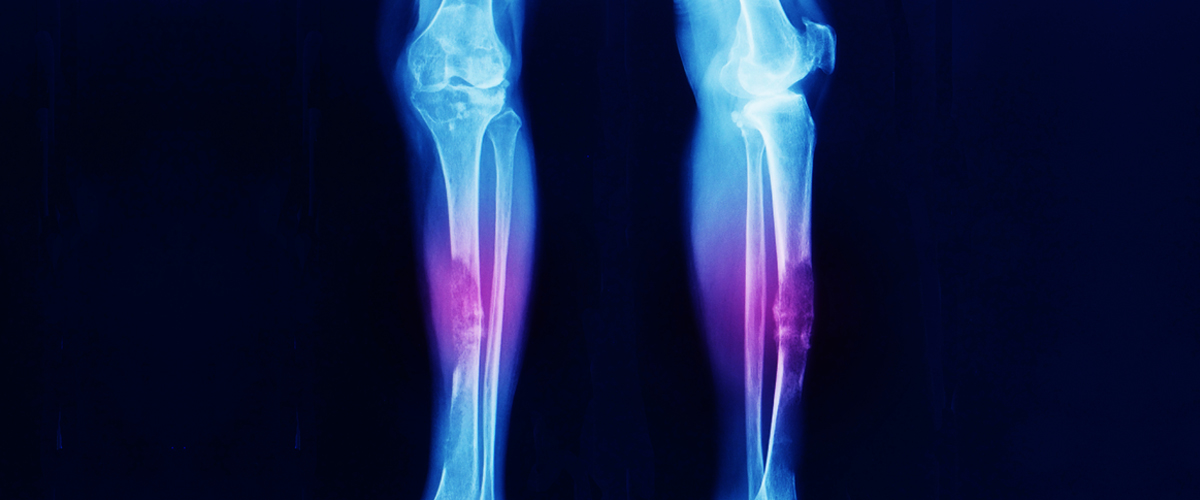 Bone Cancer: What to Know