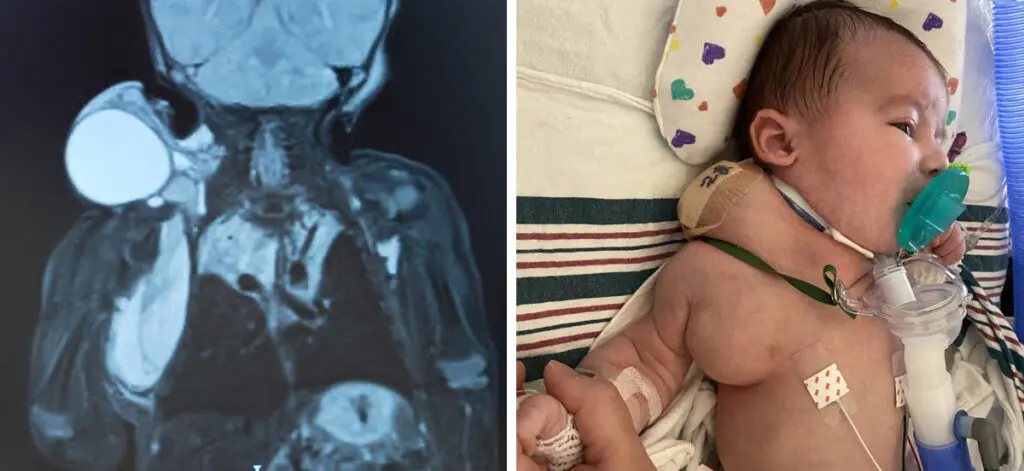 Scans showed that Finnley’s lymphatic malformation