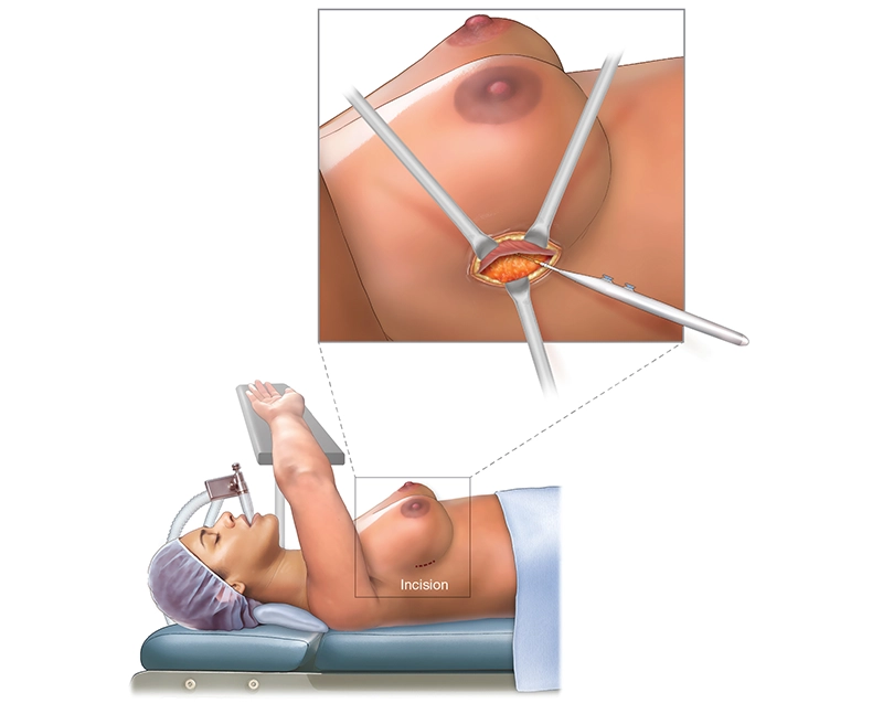 Illustration of a patient getting an endoscopic nipple-sparing mastectomy, showing the incision along the side of the breast and instruments going into the incision.