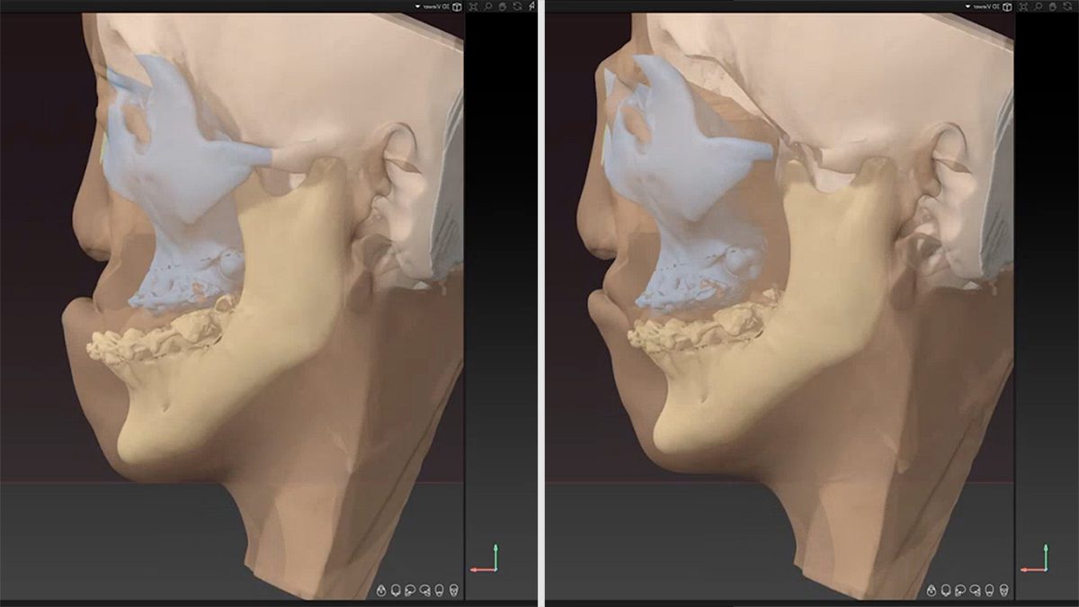 For the craniofacial disjunction surgery, Dr. Imahiyerobo cut the midfacial bones, separated them from the skull, and moved them forward. In doing so, Jade’s eyes, nose, teeth, and mouth became aligned.