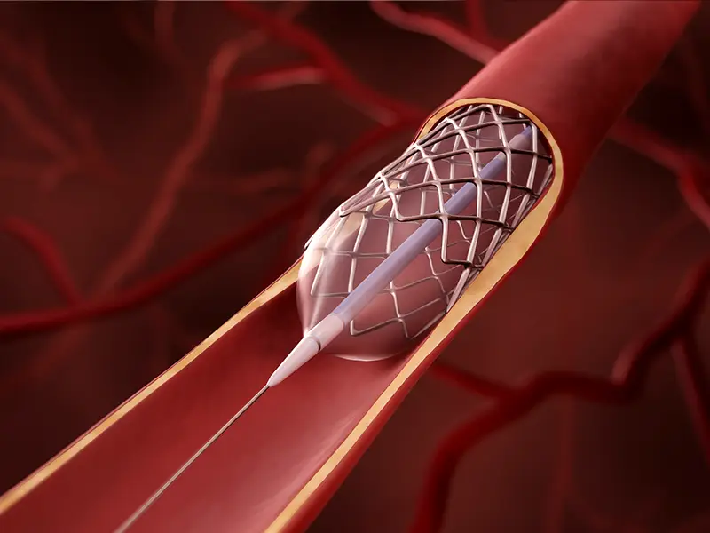 5-Year Outcomes Show PCI Can Be As Effective As Bypass In Treating CAD