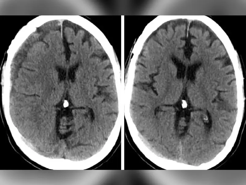 Nejm Study Highlights Mma Embolization Effectiveness For Subdural Hematomas