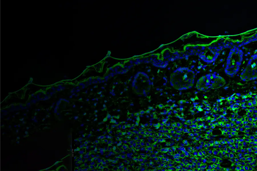 A Decade Of Results On Nivolumab And Ipilimumab For Advanced Melanoma 