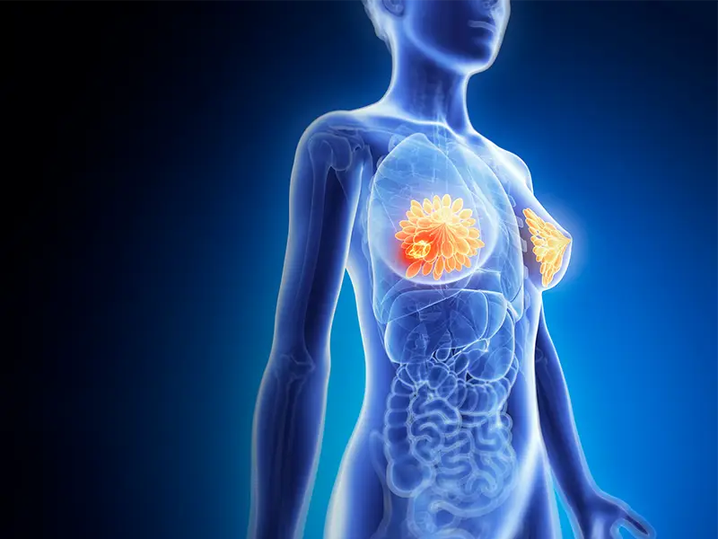 Novel Drug Regimen Shows Promise In Early-Stage Breast Cancer