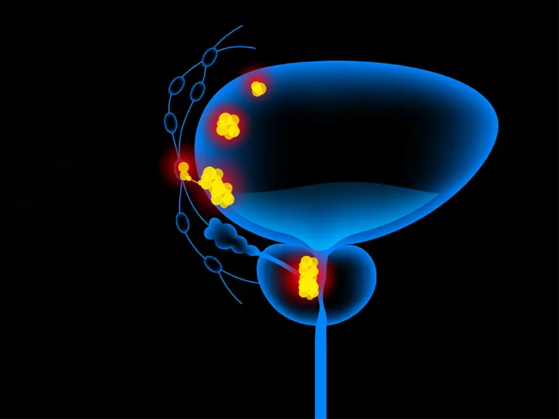 Deep Learning Helps Predict Treatment Response In Muscle-Invasive Bladder Cancer 