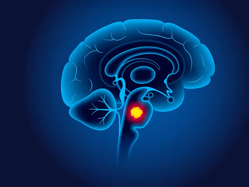 Novel Treatment Method Can Address Aggressive Pediatric Brain Tumor