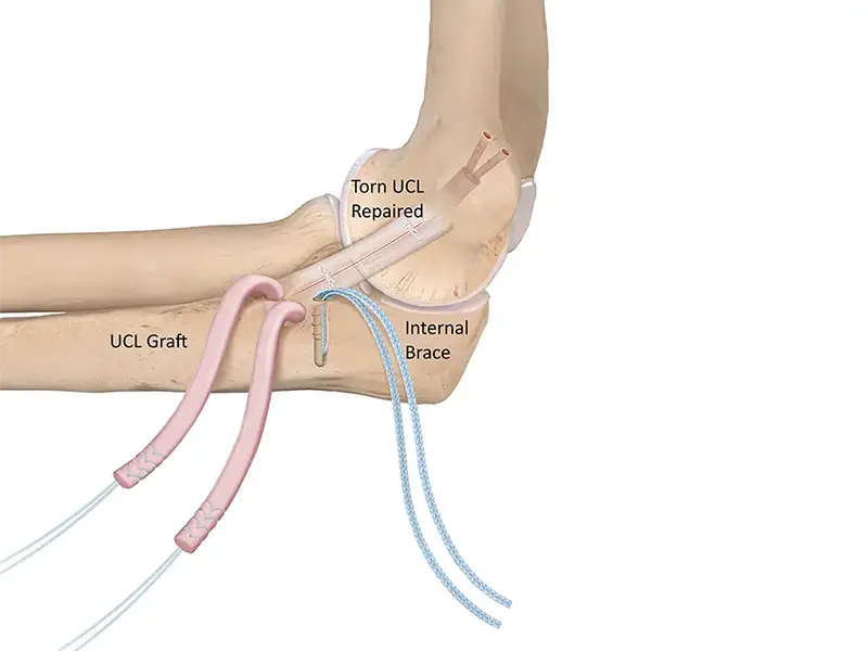 Evolving Tommy John Surgery For Modern Baseball Players
