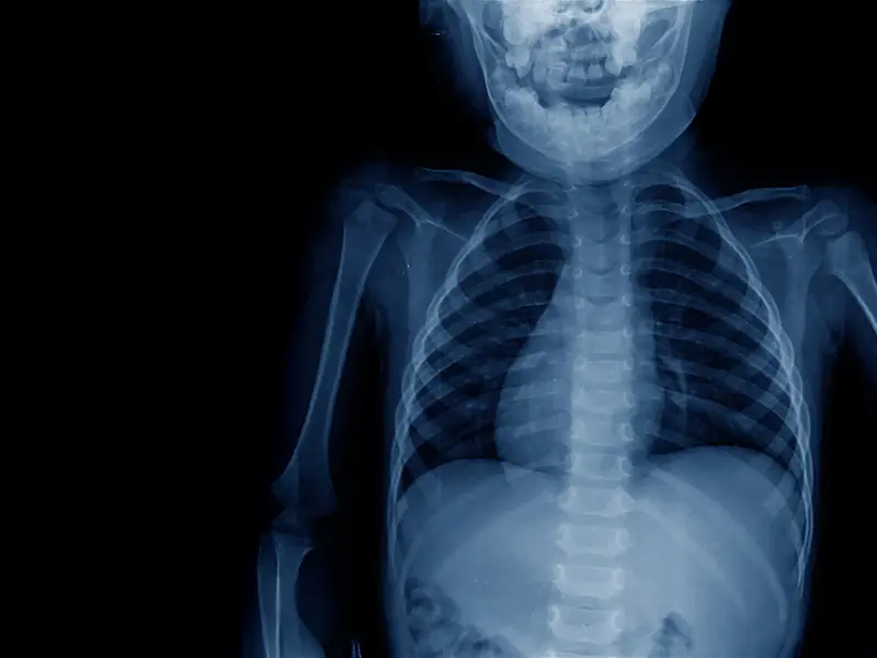 Dual-Specialty Approach Improves Outcomes In Pediatric Spine Cases