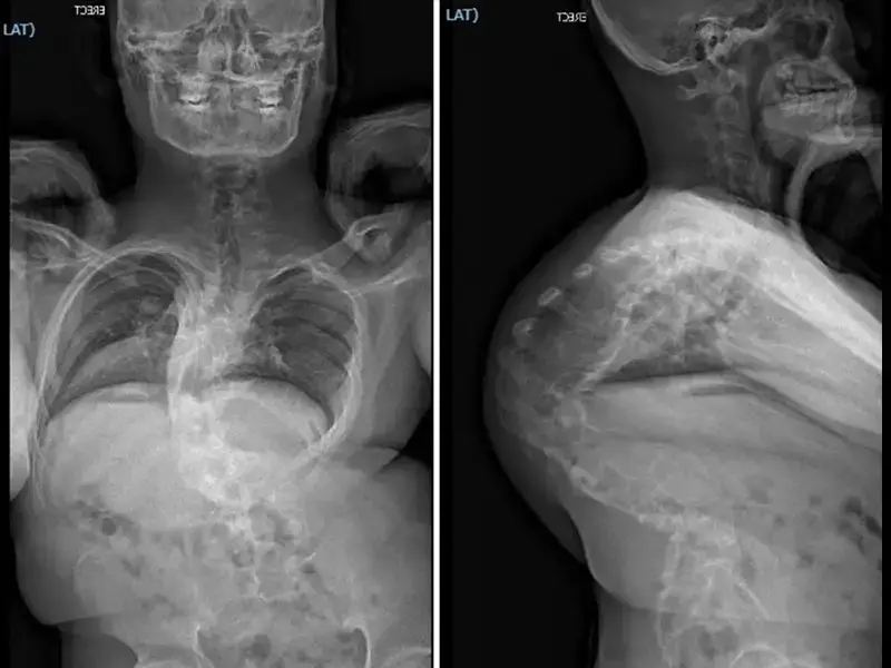 Extensive Multistage Spine Surgery Transforms A Severe Case Of Kyphoscoliosis