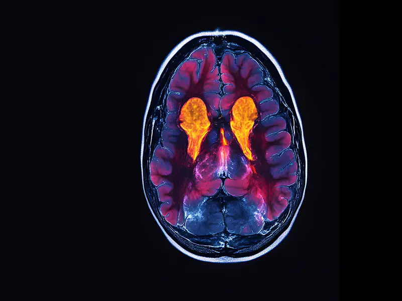 AI Model May Help Predict Onset Of Schizophrenia After Early Psychosis