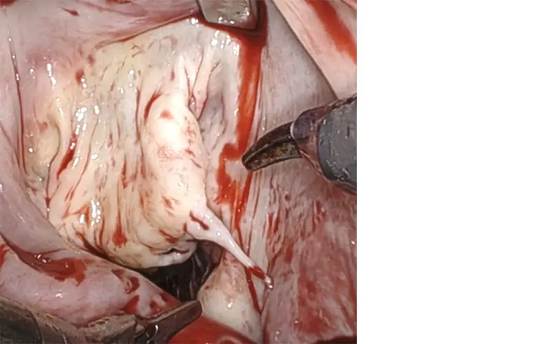 Anterior mitral valve leaflet during robotic repair