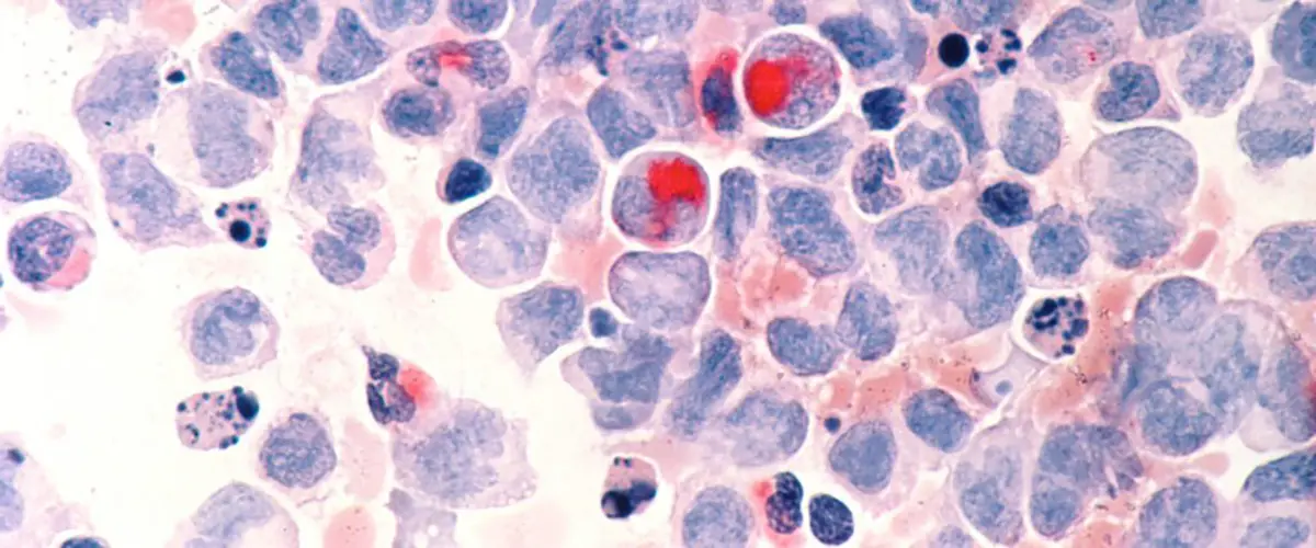 blood cells and cancer cells under a microscope