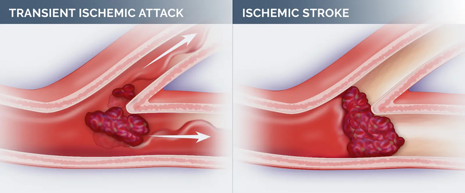 Illustration showing difference between a transcient ischemic attack and an ischemic stroke