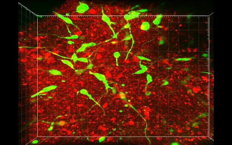Confocal microscopy showing a brain organoid (red) and glioma cells (green) five days post co-culture.