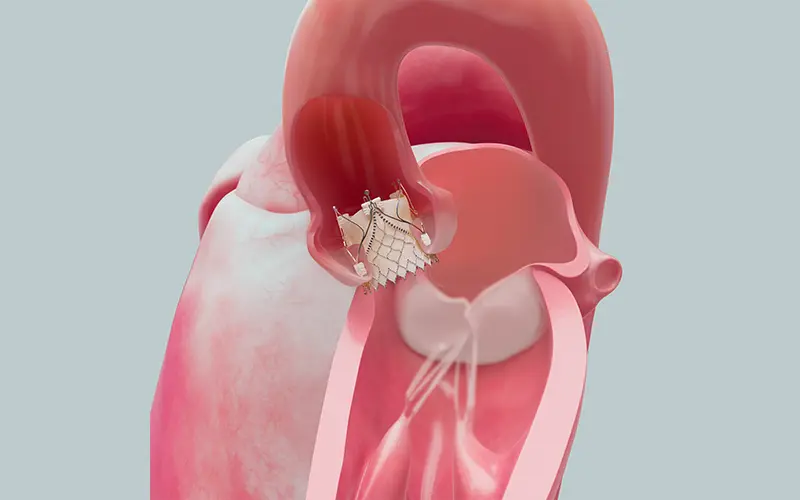 Trilogy transcatheter system for the aortic valve being shown inside an illustration of a heart.