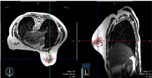 Evidencing the Future of Breast Radiotherapy: Insights from Dr. Rahimi