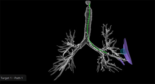 3D map of the lungs