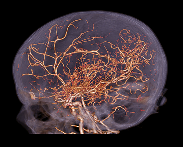 This lateral (from the side) 3D reconstruction from a CT Angiogram from a patient with moya moya disease shows the typical findings of marked enlargement and increased number of basal perforators to compensate for the vascular occlusive changes of the dis