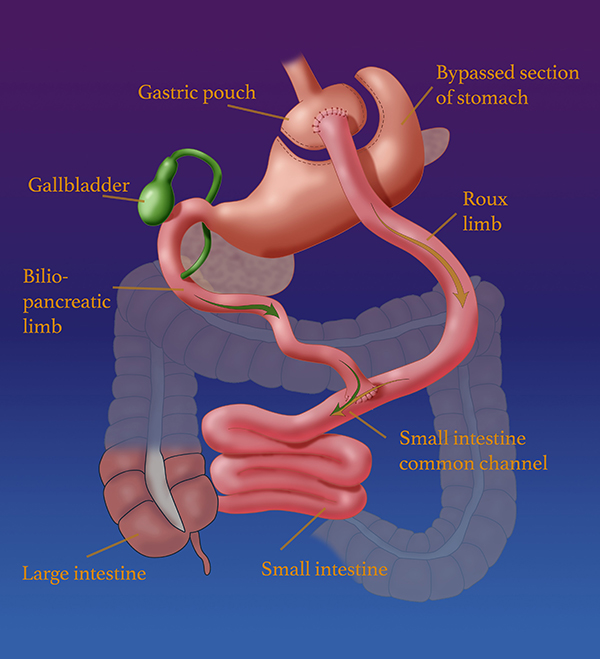 Roux-en-Y (RNY) gastric bypass is a weight loss surgery, or bariatric surgery, that is performed on patients who have tried and failed to lose weight losing using traditional methods. In Roux-en-Y gastric bypass, a small pouch at the top of the stomach is